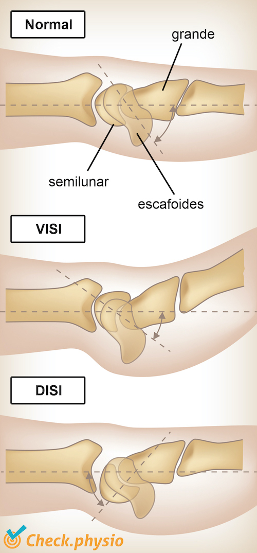afbeelding_alt_pols-VISI-DISI