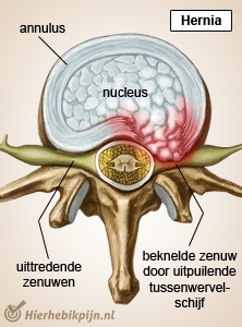 columna columna vertebral vértebra disco intervertebral hernia nervios 