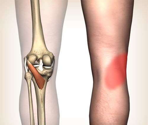 Programa de ejercicios en línea Rodilla del saltador