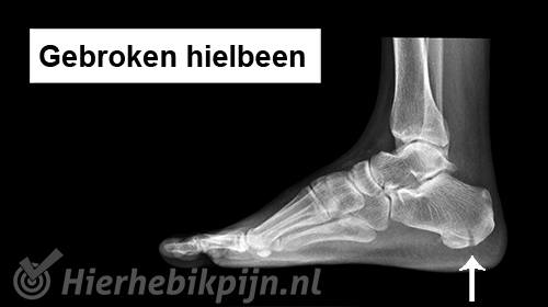 Gebroken hielbeen calcaneus fractuur voet rontgen